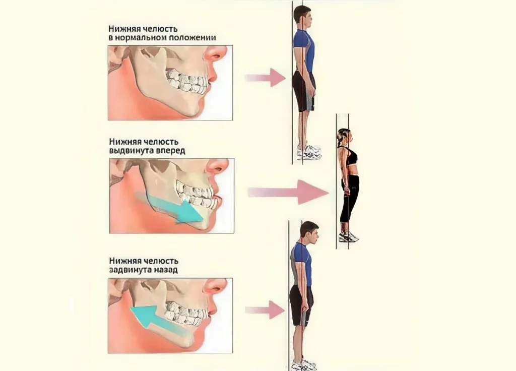 Влияние осанки на прикус