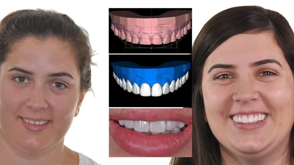 Виниры до и после с компьютерным дизайном