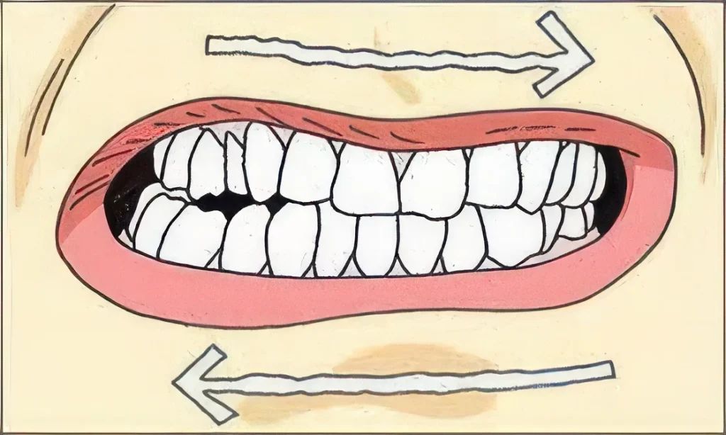 Скрежет зубов (бруксизм)