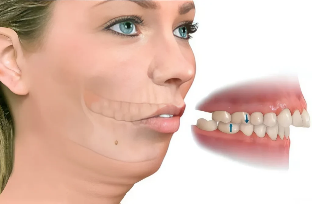 Дистальный прикус