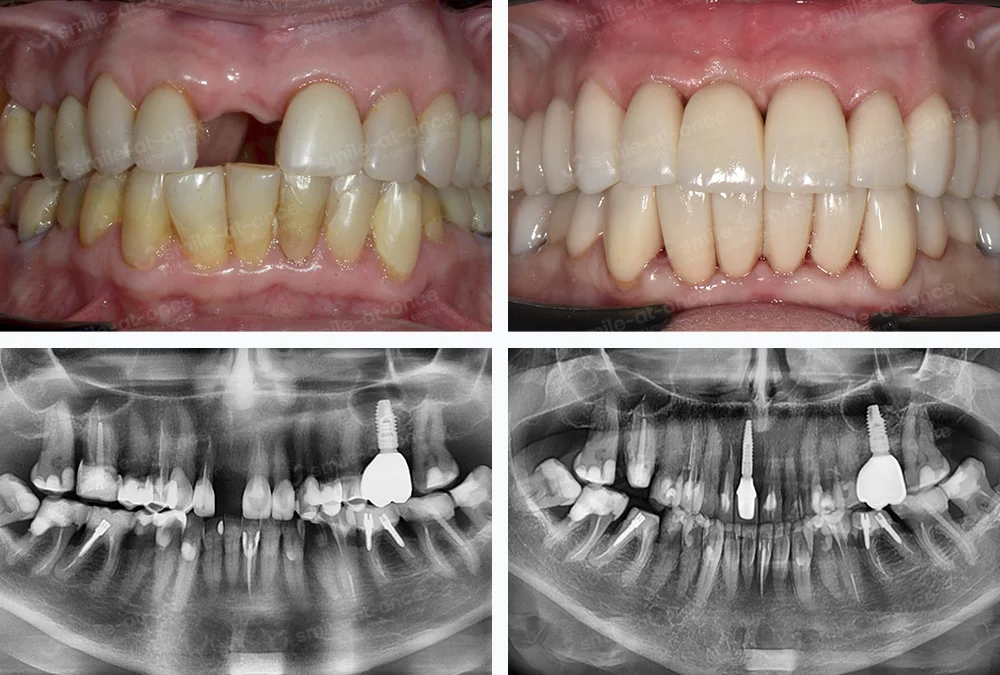 Пример одиночной имплантации Nobel Speedy