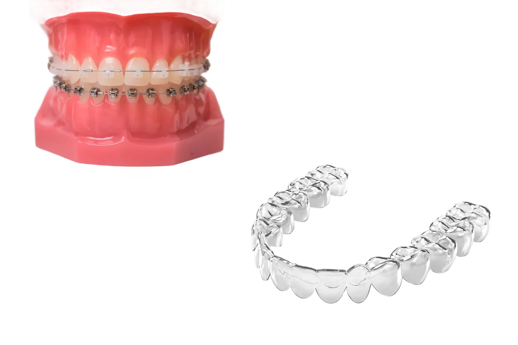 Брекеты или элайнеры?