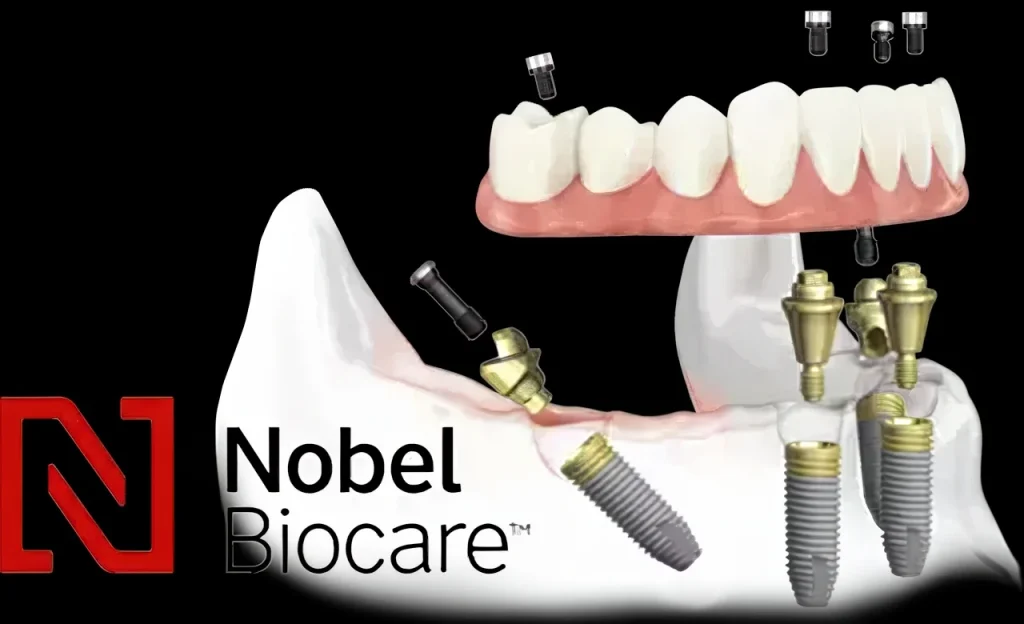 Имплантация Nobel Biocare