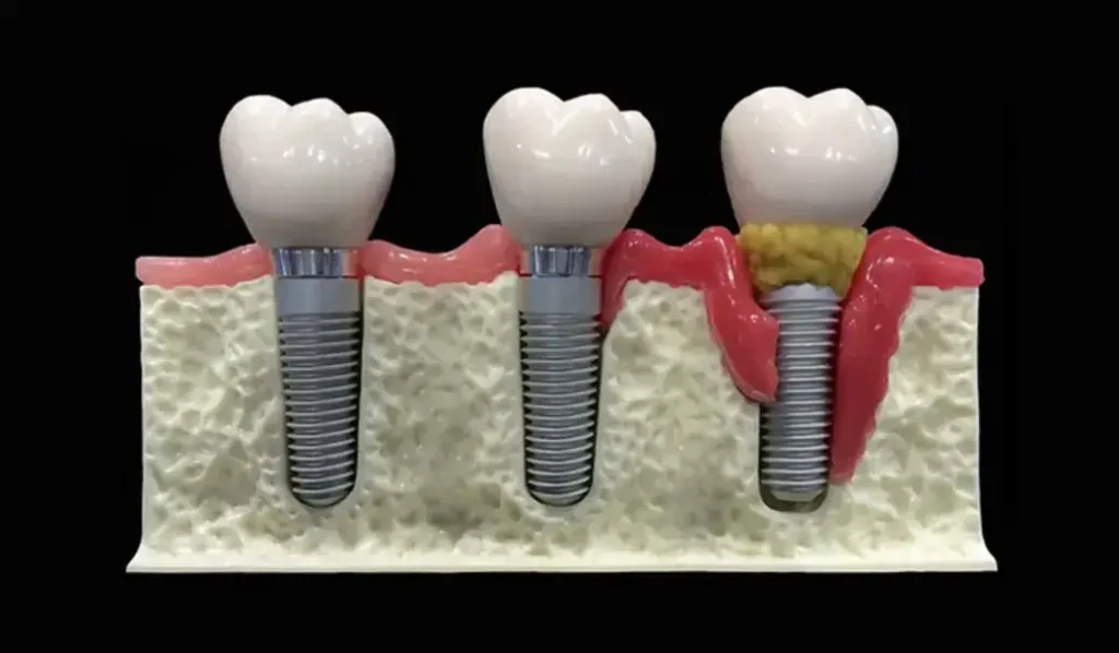 Состояние десен влияет на приживаемость имплантов
