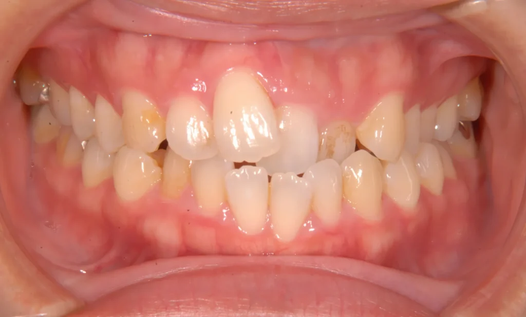 Перекрестный прикус