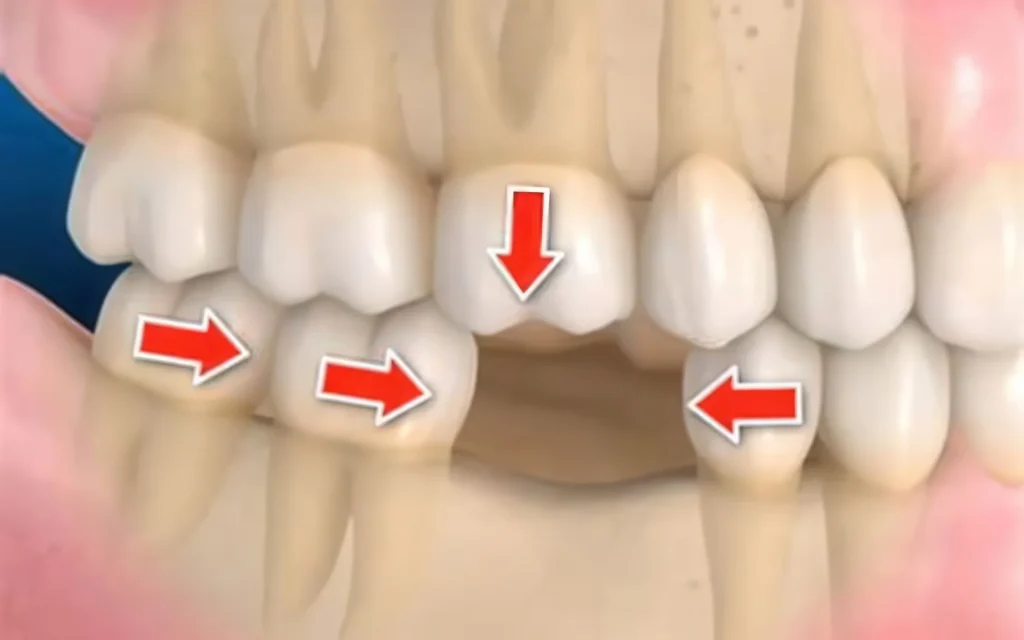 смещение зубов