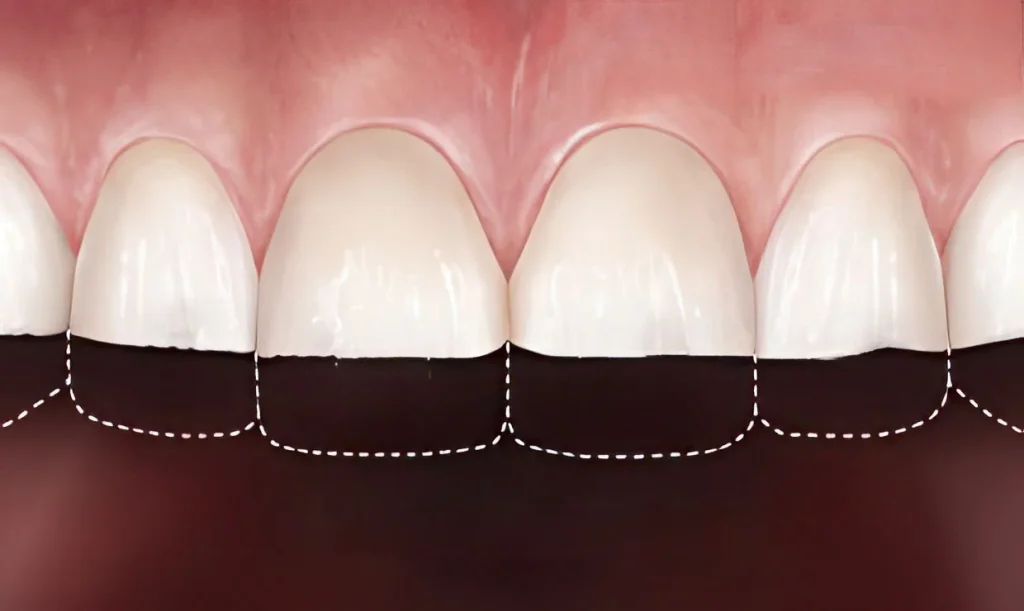 Стираемость зубной эмали и уменьшение высоты коронок