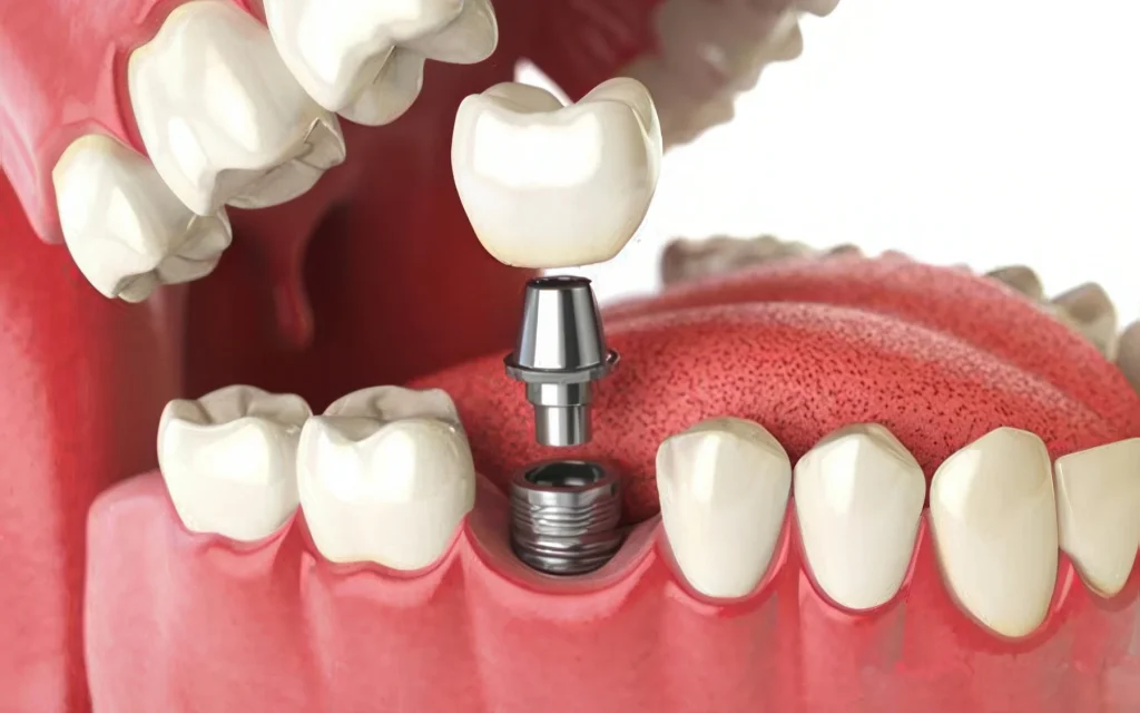 Роль гнатологии при имплантации зубов