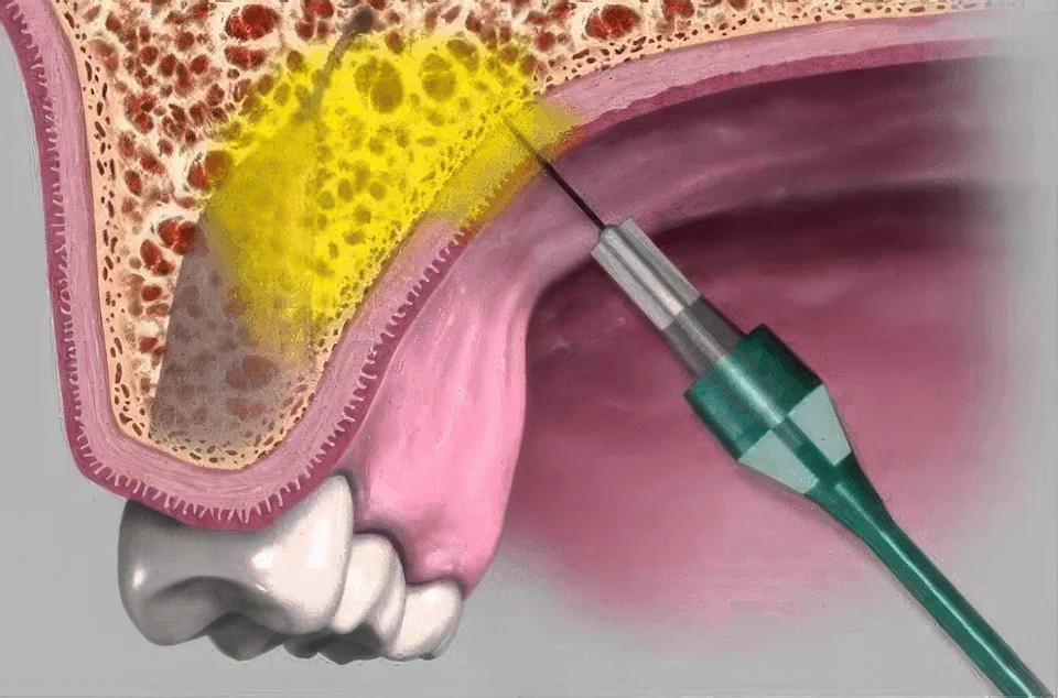 Инфильтрационная анестезия