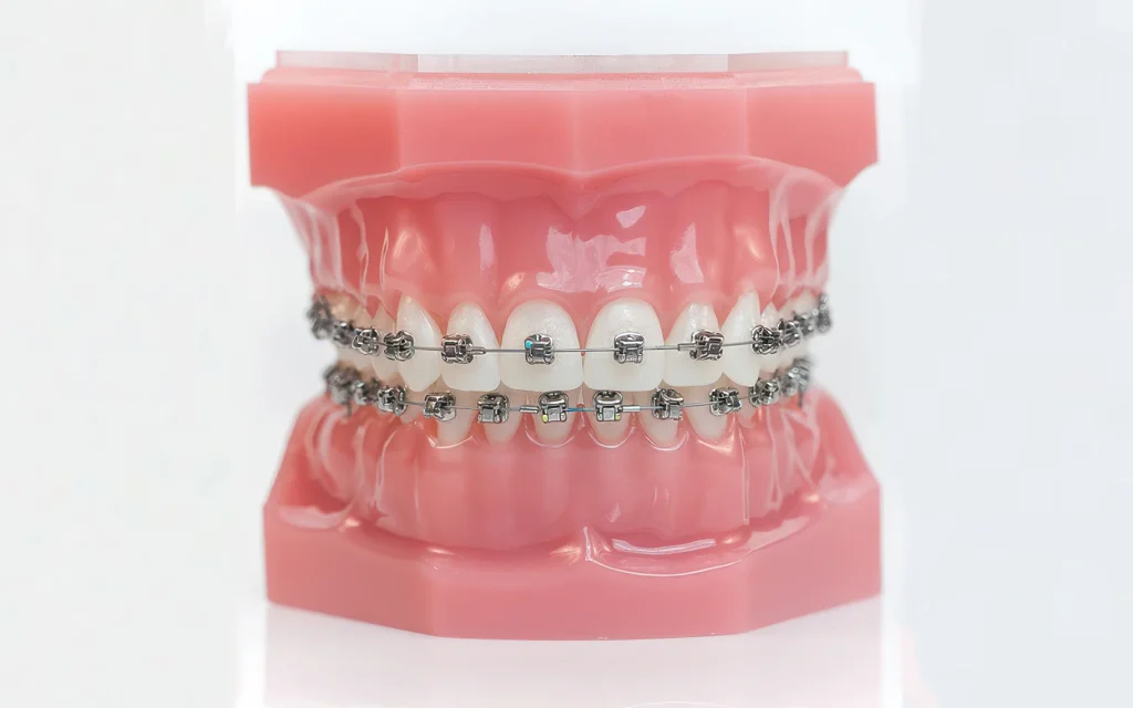 Металлические брекеты