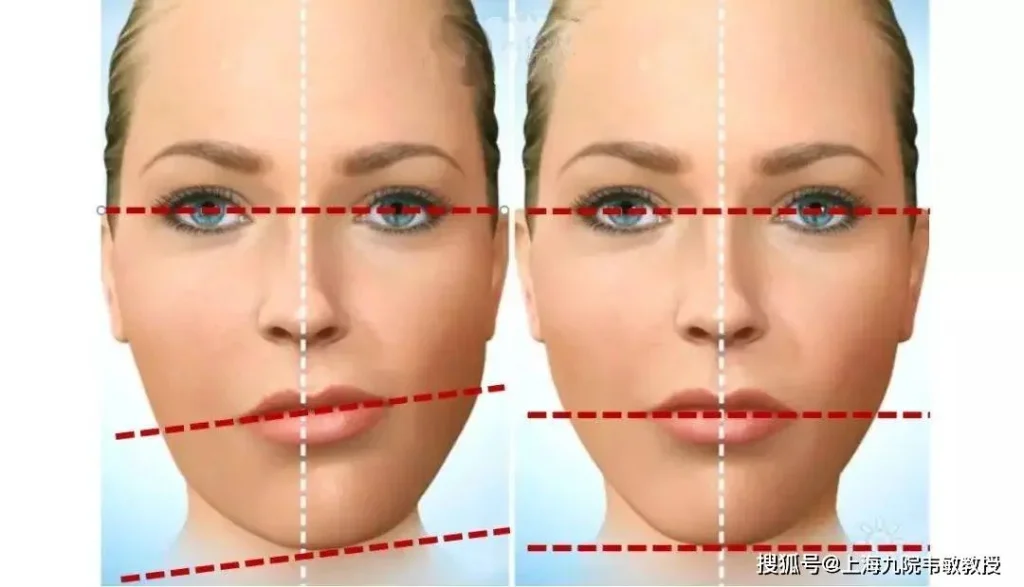 Асимметрия лица