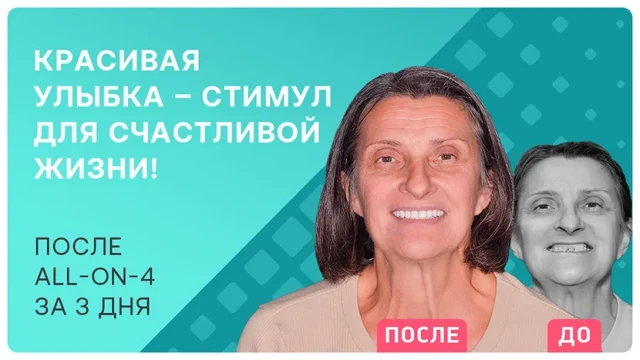 Голливудская улыбка после all-on-4
