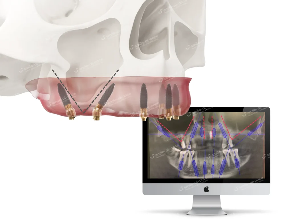 Цифровое моделирование имплантации