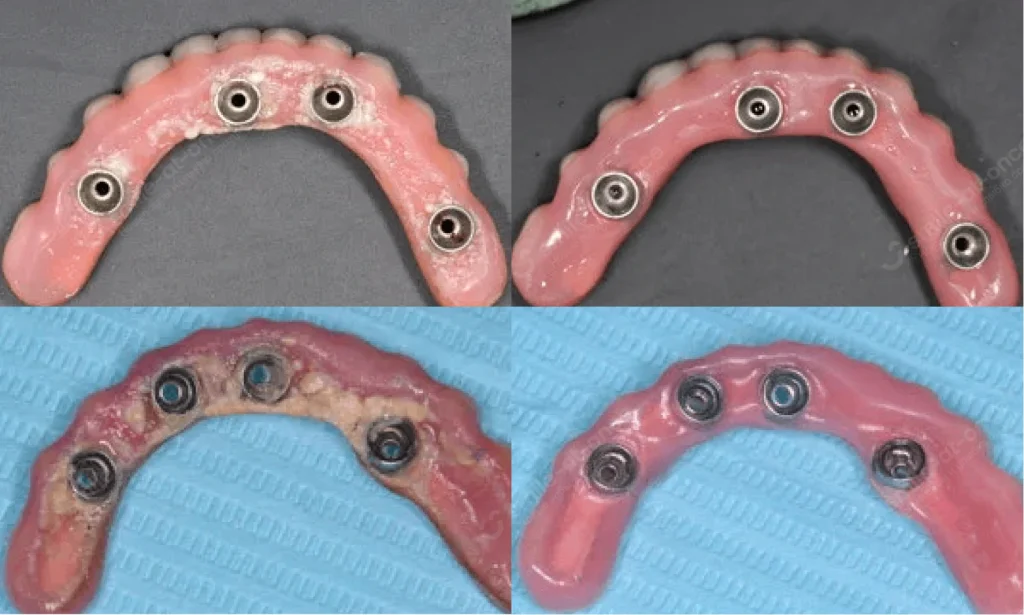 Зубные протезы до и после профчистки