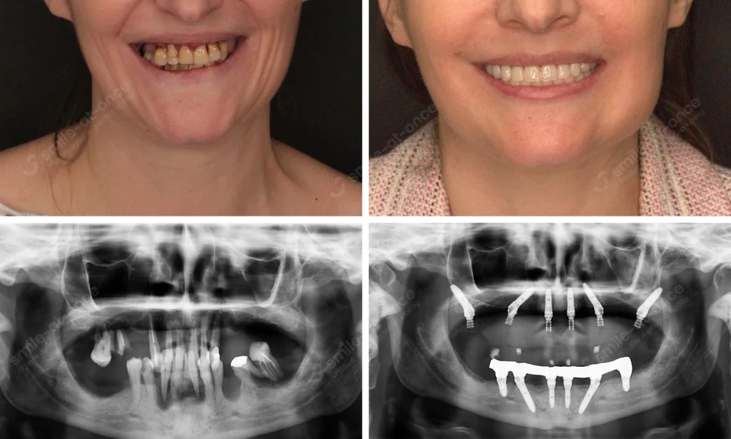 До и после имплантации зубов