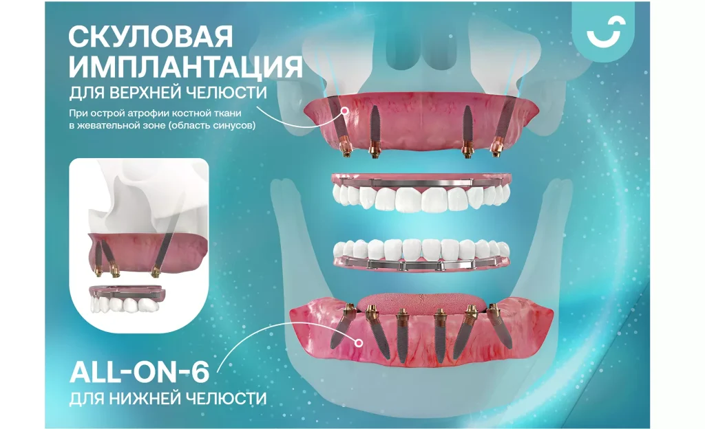 Скуловая имплантация All-on-4 и методика All-on-6